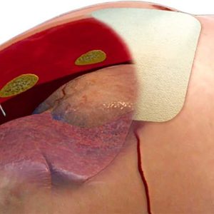 Alternative view of ARS for Needle Decompression (14 GAUGE X 3.25 IN.)